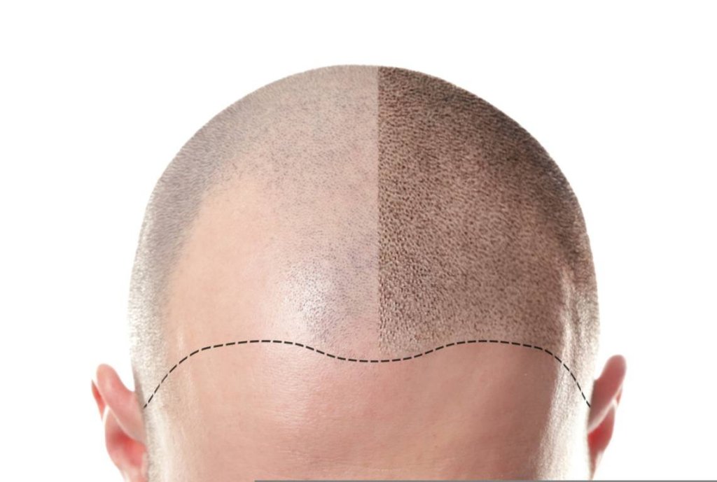 10 Important Questions to Ask Before Getting a Hair Transplantation