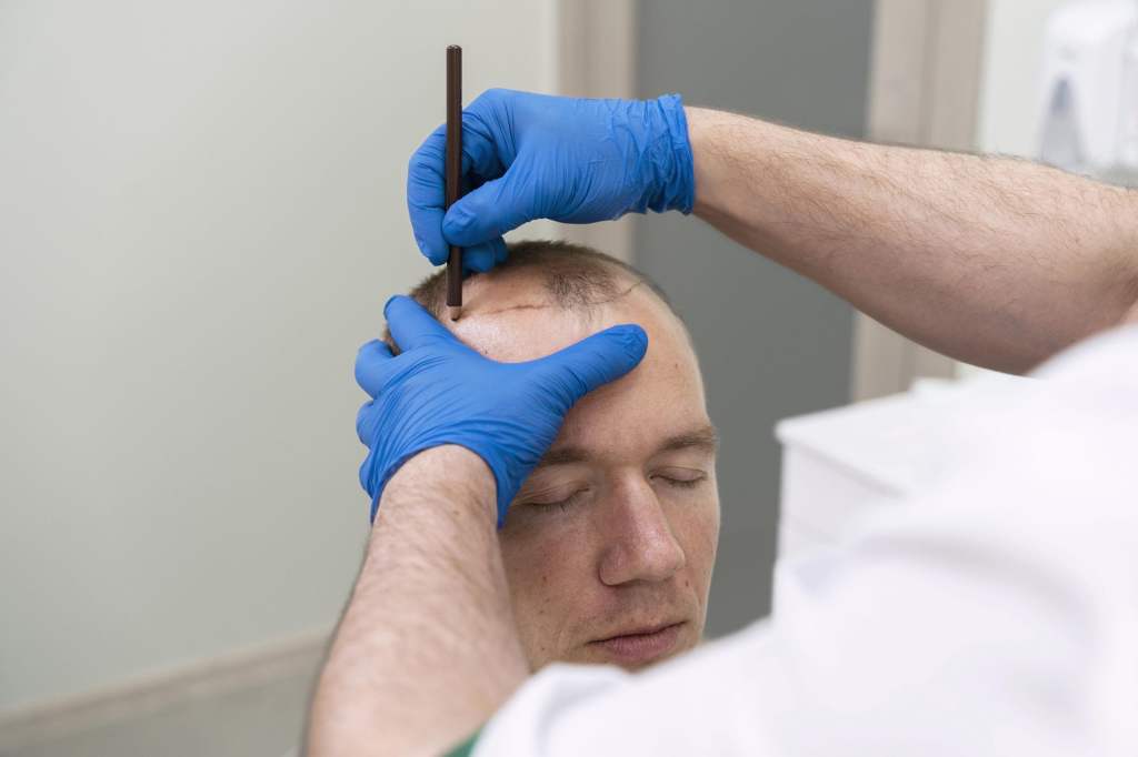 Benefits and Risks of Hair Transplantation