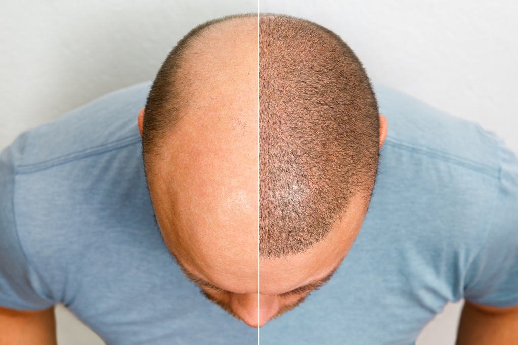 Myths and Misconceptions About Hair Transplantation Debunked