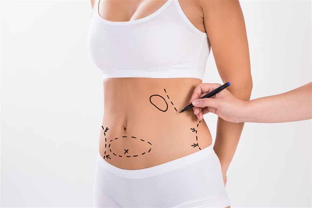 What Is Liposuction Removal Fat ?
